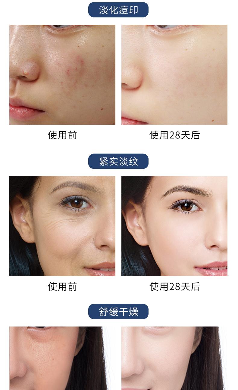 梵西蓝铜胜肽修护冻干粉寡肽原液去淡化祛痘印痘坑收缩毛孔精华液44支